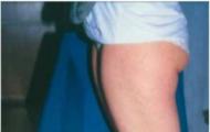 Синдром «разболтанных» суставов: когда гибкость оказывается болезнью Эластичные связки у ребенка